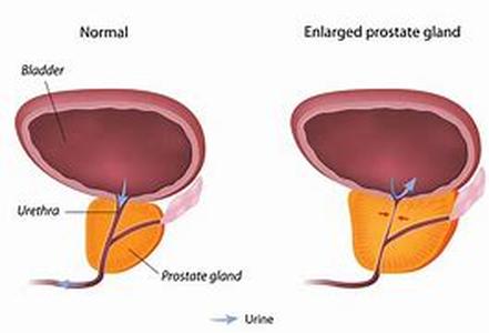 Prostate Exam  Difficulty in urinating may not be directly related as the primary symptom of sexually transmitted disease or problems in the nephrons kidneys, however those who have any of thesis health problems may have undergone this predicament