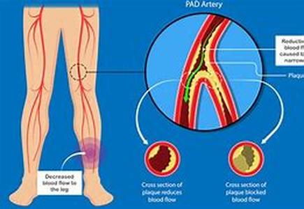 Pagets disease