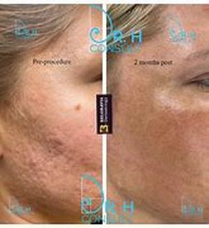 Laser Resurfacing