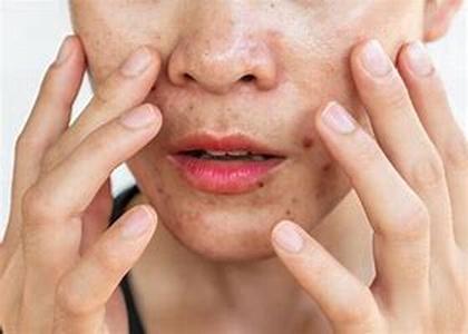 Acne Treatment, Best Acne Treatments
