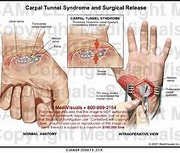 Carpal Tunnel Herbs and Vitamins