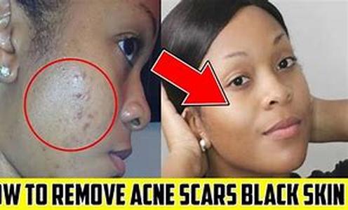 Acne Treatment and Products