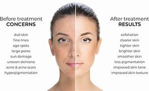 Skin Problem- Spider Veins And How To Get Rid Of Them