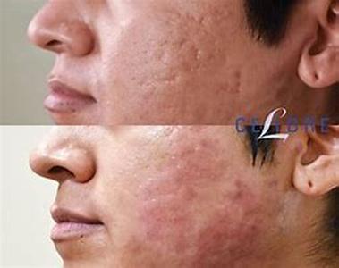 The Acne and Diet Connection