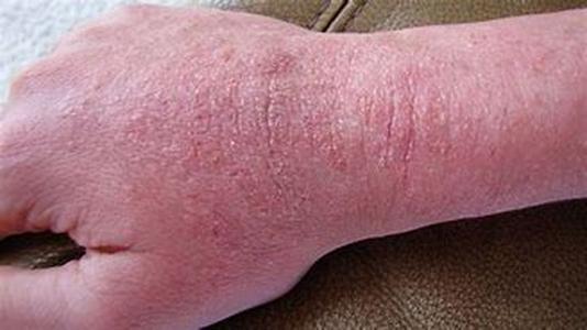 Eczema and Psoriasis - An Inexpensive and Effective Treatment