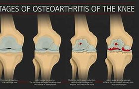 Arthritis