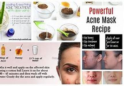 Acne Causes