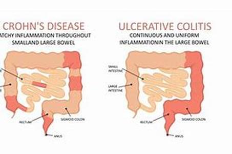 Types of and Causes of Cerebral Palsy