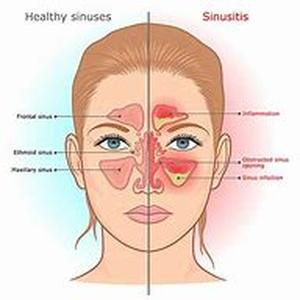 Single-Dose Oral Antiviral Therapy Found To Accelerate Healing Time Of Cold Sore Outbreaks
