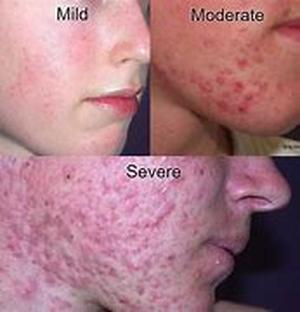 Phyto Estrogen Reduce The Risk Of Certain Cancers