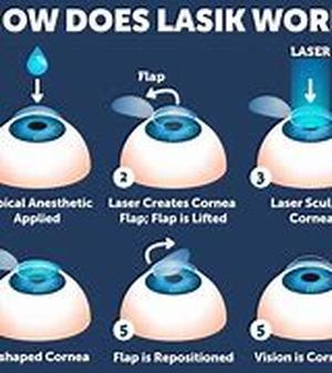 LASIK Procedures Explained - Can It Help Your Blurred Vision