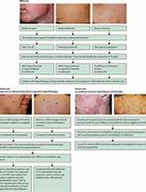 Acne Rosacea