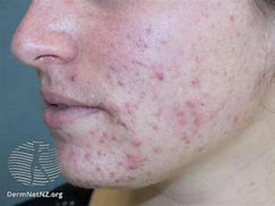 Acne- Prevent Acne In A Sure And Simple Way