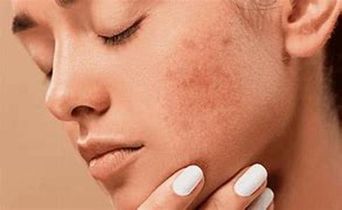 Acne Remedy: what worked for my acne was the drug-free way (part 3)