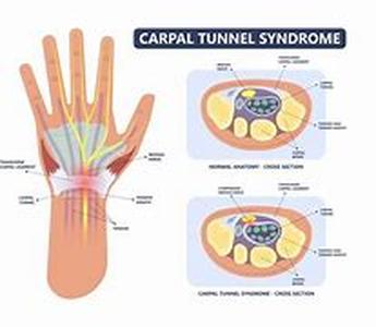Carpal Tunnel Ergonomics