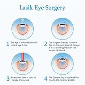 Lasik Procedure