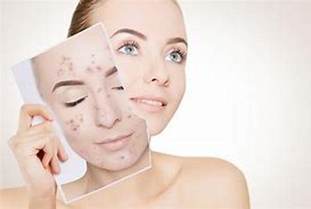 Acne Cleanser, Acne Lotion And More  A Quick Look At Common Acne Products