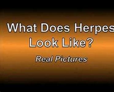 Herniated Disk and Back Pain