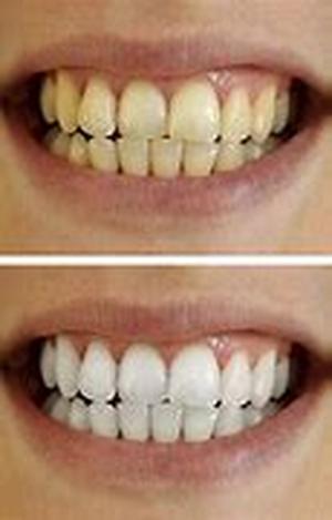 Teeth Whitening Lets You Smile Confidently