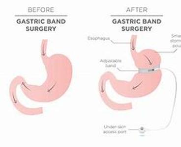 Kidney Back Pain