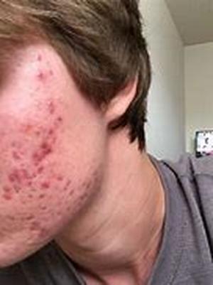 Acne- Is It Contagious