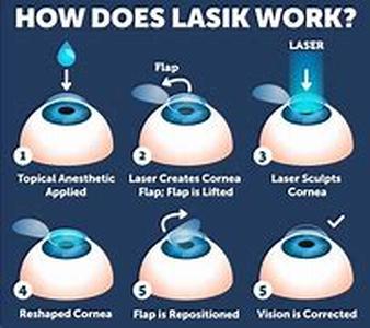 LASIK Eye Surgery: Safe or Dangerous