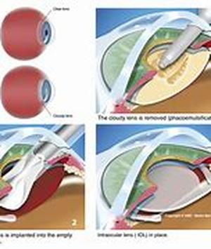 Keyword Phrase: cataract surgery in Chicago