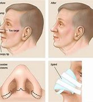 Rhinoplasty in New York City