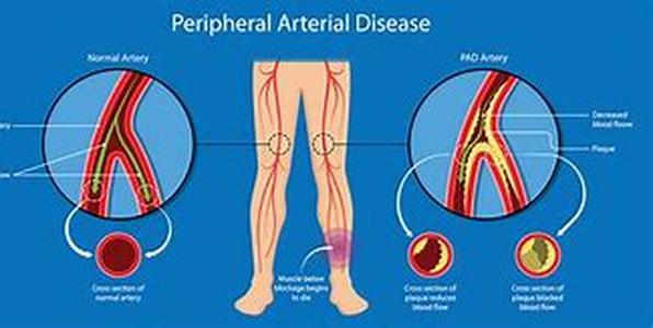 What is Coronary Artery Bypass Surgery