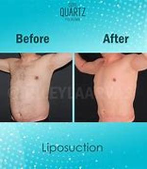 Key words: liposuction alternatives