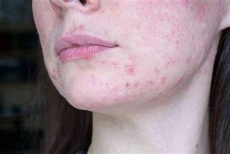Acne Laser Treatment