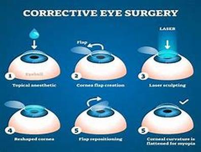 Lasik Vision