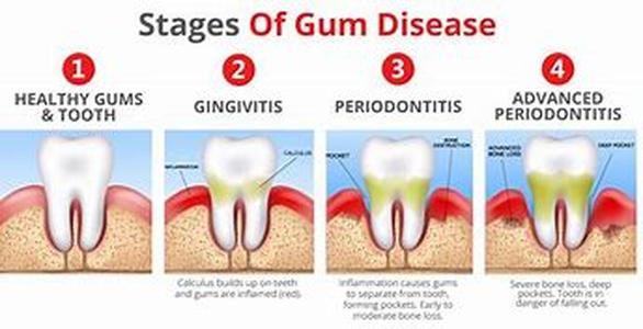 Gum Disease During Pregnancy Is A Serious Concern For Many Pregnant Women Or Those Who Are Planning To Have A Baby In The Near Future