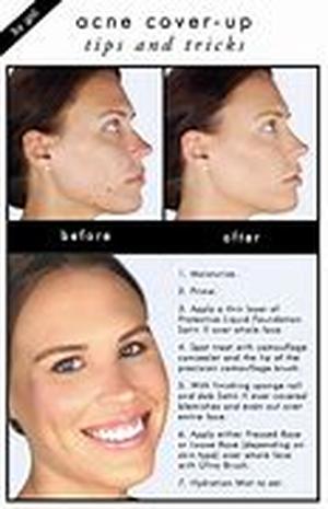Prescription Acne Medicines