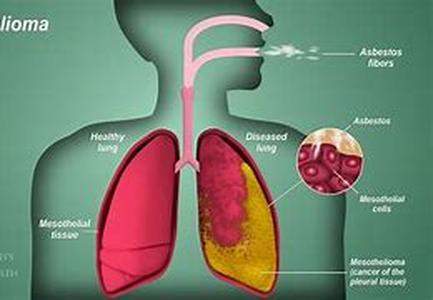 Asbestos Exposure It Is A Borne Fact That Whichever Corner You Turn To, There Are Imposing Threats Which May Not Seemingly Appear As Innocuous