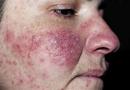 Prescription Acne Medicines