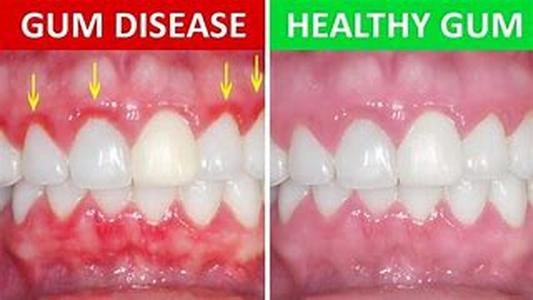 Siberian Ginseng To Fight Fatigue, Stress And Herpes