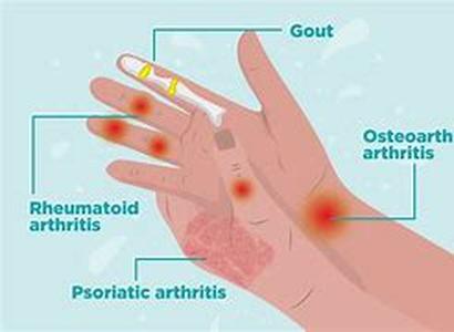 Arthritis Cure