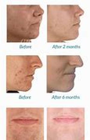 Acne and its treatment