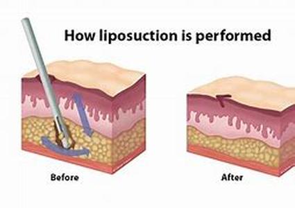 Laser Prostate Treatment On BPH Now That The Prostate Has Become A World Concern, Many Men Approaching 40s And 50s Are Being Persuaded To Arrange For Themselves An Annual Routine Testing Involving Prostate Problem Detection By Means Of PSA Testing And DR