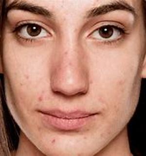 Acne Solutions