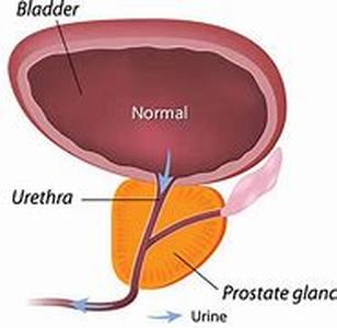 Prostate Cancer Treatment  Prostate cancer is cause by the growth of abnormal cells that form a mass on the prostate called malignant tumor