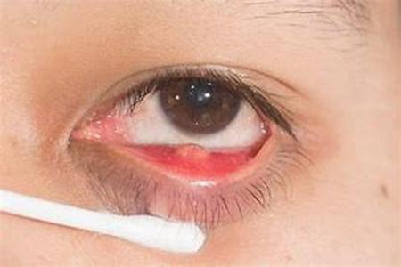 What Food Makes Rosacea Worse