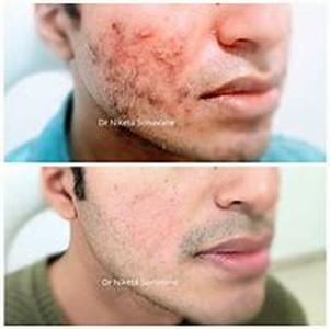 Acne Skin Care Pointers