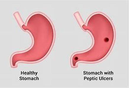 Usual Symptoms of Lymphoma