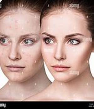 Acne: A Basic Understanding