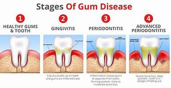A Natural Remedy for Gingivitis, Toothaches, and Mouth Sores