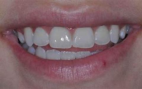 Products For White Teeth