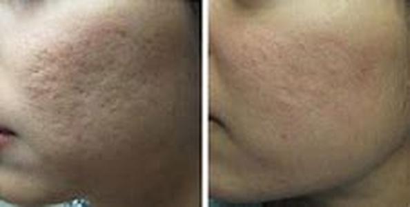 Acne Scarring