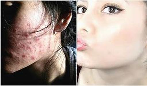 Acne Vulgaris and Its Causes